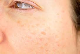 Hyperpigmentation can occur in spots, patches, or the entire face and/or body. How To Treat Dark Spots On Your Skin Isdin S Blog