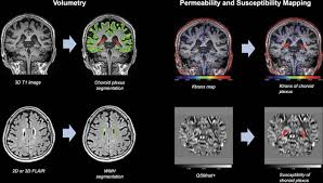 Image result for Choroid