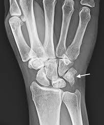 Image result for Pisiform Bone