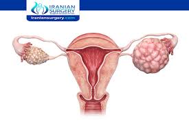 Stage Ovarian Cancer Ovarian Cancer Progression Timeline Iranian Surgery