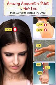 Acupuncture For Hair Loss Problem Hair Loss Hair Loss Remedies Women Hair Loss Treatment