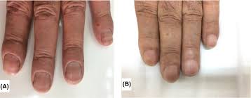 Image result for Muehrcke Line