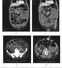 Cecum Cancer: Symptoms, Diagnosis, Treatment, And More