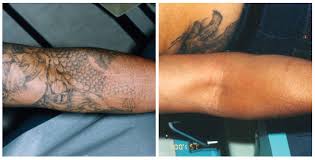 San diego laser removal clinic (sdlr) started in partnership with propaganda tattoo in 2010. Laser Tattoo Removal By South Coast Medspa 877 650 Scms 7267 Laser Tattoo Removal Before And After Laser Tattoo Removal Los Angeles Newport Beach San Diego Orange County