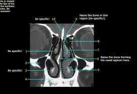 A anterior nasal fossa, level of the uppermost insertion of both uncinate processes on the. Nasal Cavity Ct Coronal Plane Diagram Quizlet