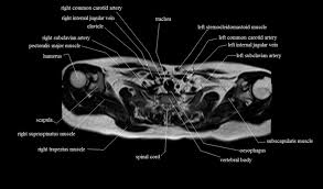 O muscles—sternocleidomastoid, anterior and middle scalene, infrahyoid, pectoralis major and o diaphragm. Chest Anatomy Mri Chest Thorax Axial Anatomy Free Cross Sectional Anatomy