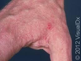 Image result for scabies human bites