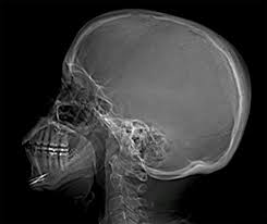Image result for Skull XRay