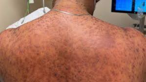 Image result for Generalized Rash