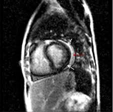 La miocardiopatía dilatada (md) es la complicación más grave a largo plazo. Miocarditis Trastornos Cardiovasculares Manual Msd Version Para Profesionales