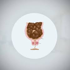 Image result for Fecal Incontinence