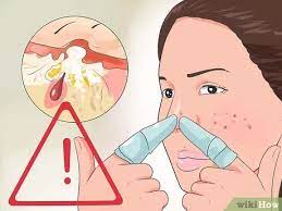 3 Ways To Heal A Pimple - Wikihow Life