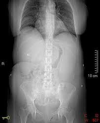 Image result for Splenomegaly