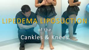 Lipedema Leg Liposuction Surgery Results Lipo 360 Legs Cankles Kne Lipedema Lipedema Legs Liposuction