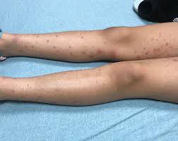 Polyarticular joint disorders may affect. Rash Triggers Joint Pain In An 8 Year Old Girl Contemporary Pediatrics