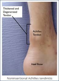 In most cases, nonsurgical treatment options will provide pain relief do not over stretch your achilles tendon and focus on strengthening surrounding musculature in the. Achilles Tendinitis Bouldercentre For Orthopedics Spine
