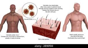 Image result for Varicella zoster on human skin