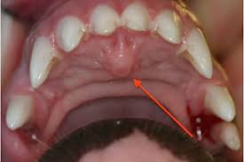 The lump that develops in the mouth or even the palate may be a result of the blockage of the salivary glands. What Is That Incisive Papilla Clarendon Animal Care