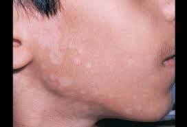 Oleh itu, perlunya menjaga penampilan diri dengan mengenali bagaimana nak hilangkan panau di muka, badan, kaki atau tangan dengan cepat! Klinik Avicenna Panau Tinea Versicolor Panau Ataupun Facebook