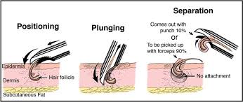 Understanding hair follicles is key in growing healthy hair. Dr Sanusi Umar Invents New Hair Restoration Tools For Afro Textured Hair Fue Hair Transplants Possible For Tight Curly Hair Plastic And Reconstructive Surgery Journal