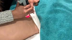 D elicate machine pictures and catalogue, easy for distributors to do marketing work. Bikini Line Laser Hair Removal Treatment Youtube