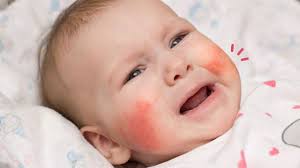 Bagi bayi yang lebih tua, ia kelihatan seperti jerawat putih pada muka atau bahunya. 5 Cara Alami Menghilangkan Ruam Di Wajah Bayi Orami