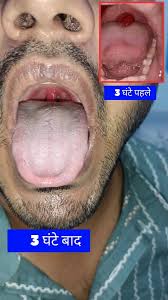 Image result for Uvulitis
