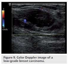 How is inflammatory breast cancer different from other breast cancers? Color Doppler Sonography Characterizing Breast Lesions