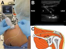Image result for Axillary Nerve Block