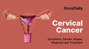 Image result for Cervical Cancer