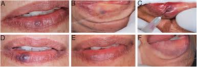 Image result for Diascopy