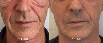 How long will my results last with morpheus8? Morpheus8 Radio Frequency Skin Tightening Treatment Aesthetic Treatments In Uk