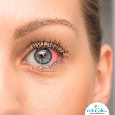 Learn about all the causes and treatments for red eyes. Red Spot On Eye Causes Symptoms And Treatment Netmeds