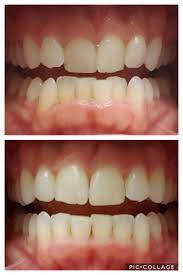 Squeeze a small amount of gentle, liquid soap into a warm, but not hot, cup of water and mix to create suds. My Before And After Tip For Cleaning Your Retainer I Let Them Sit In Mouthwash For A Bit Then I Use A Baby Toothbrush Smiledirectclub