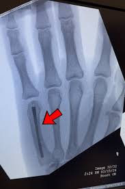 Image result for Hand Fracture