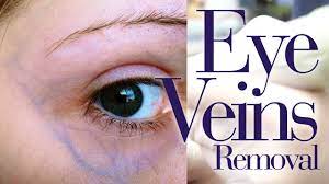Veins under your eyes can make you look old, tired and uninterested in what you are doing. Yag Laser Eye Treatment Used To Eliminate Veins Under The Eyes Youtube