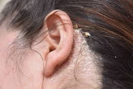 Image result for dry scabs on the head in children