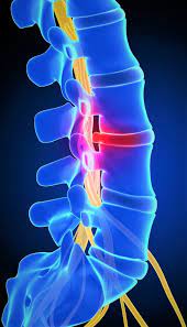 Maybe you would like to learn more about one of these? Hernia De Disc Tot Ce Trebuie Sa Stii De La Simptome La Tratament Si Moduri De Prevenire Medlife