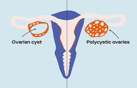 Can ovarian cysts cause hair loss; What S The Difference Between Ovarian Cysts And Pcos