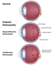 Check spelling or type a new query. South Florida Expert Retina Treatment Center Your Eye Specialists