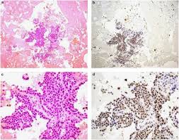 However, literature reported that patients diagnosed with this subtype showed a similar prognosis . Loss Of Expression Of Bap1 Is A Useful Adjunct Which Strongly Supports The Diagnosis Of Mesothelioma In Effusion Cytology Modern Pathology