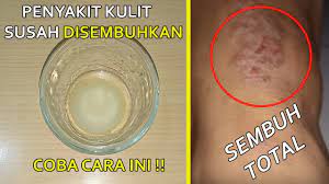 Sedangkan mukolitik merupakan golongan obat pengencer dahak contohnya ambroxol dan bromhexine. Obat Gatal Gatal Penyakit Kulit Paling Ampuh 3 Hari Sembuh Youtube