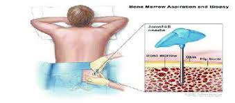 While a fever is not as common a symptom as others on this list, bone cancer can cause you to have a fever. 9 Bone Marrow Aspiration And Biopsy Source National Cancer Download Scientific Diagram