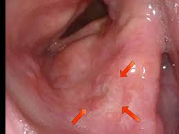 Initial symptoms of throat cancer. Throat Cancer Pictures Early Celine Dion Songs Age
