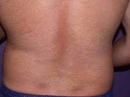 Pityriasis alba is a skin condition that commonly happens to children and to young adults, but any person can acquire it as well. Pityriasis Versicolor Deximed