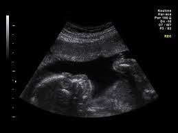 Talk to a friendly consultant to set up your appointment or. Free Pregnancy Test And Sonogram Pregnancy Test