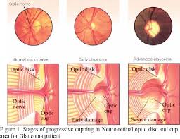 It can affect people of all this increase in pressure then damages the nerve that connects the eye to the brain (optic nerve). Convex Hull Based Neuro Retinal Optic Cup Ellipse Optimization In Glaucoma Diagnosis Semantic Scholar