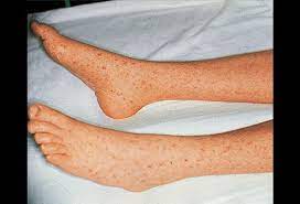 Maybe you would like to learn more about one of these? Rocky Mountain Spotted Fever Picture Image On Medicinenet Com