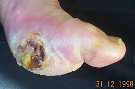 Image result for diabetic toes