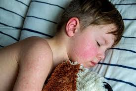 Image result for measles